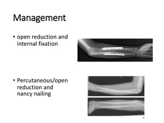 Management
• open reduction and
internal fixation
• Percutaneous/open
reduction and
nancy nailing
 