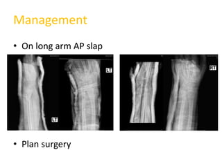 Management
• On long arm AP slap
• Plan surgery ผู้ป่วยปฎิเสธการรักษา
 