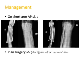 Management
• On short arm AP slap
• Plan surgery => ผู้ป่วยปฎิเสธการรักษา และขอกลับบ้าน
 