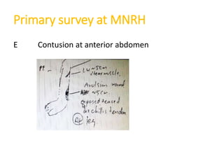 Primary survey at MNRH
E Contusion at anterior abdomen
 