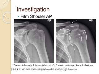 Investigation
 Film Shouler AP
1. Greater tuberosity 2. Lessor tuberosity 3. Coracoid process 4. Acromioclavicular
joint 5. ส่วนที่ซ้อนทับกันของกระดูก glenoid กับหัวของกระดูก humerus
 