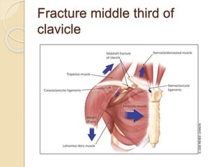 Fracture middle third of
clavicle
 