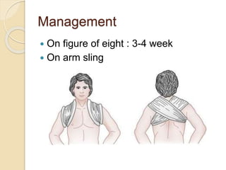 Management
 On figure of eight : 3-4 week
 On arm sling
 