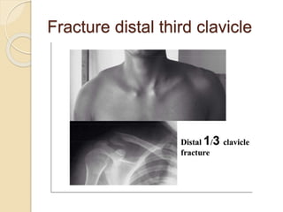 Fracture distal third clavicle
 