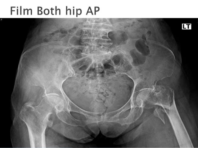 Intertrochanteric fracture