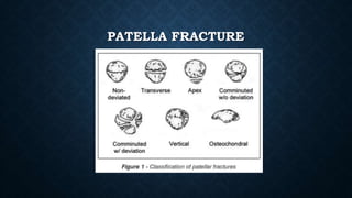 PATELLA FRACTURE
 