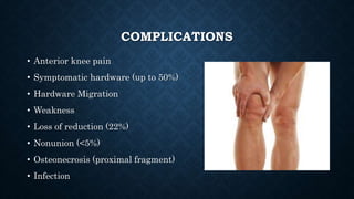COMPLICATIONS
• Anterior knee pain
• Symptomatic hardware (up to 50%)
• Hardware Migration
• Weakness
• Loss of reduction (22%)
• Nonunion (<5%)
• Osteonecrosis (proximal fragment)
• Infection
 