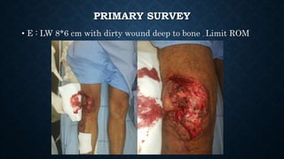 PRIMARY SURVEY
• E : LW 8*6 cm with dirty wound deep to bone , Limit ROM
 