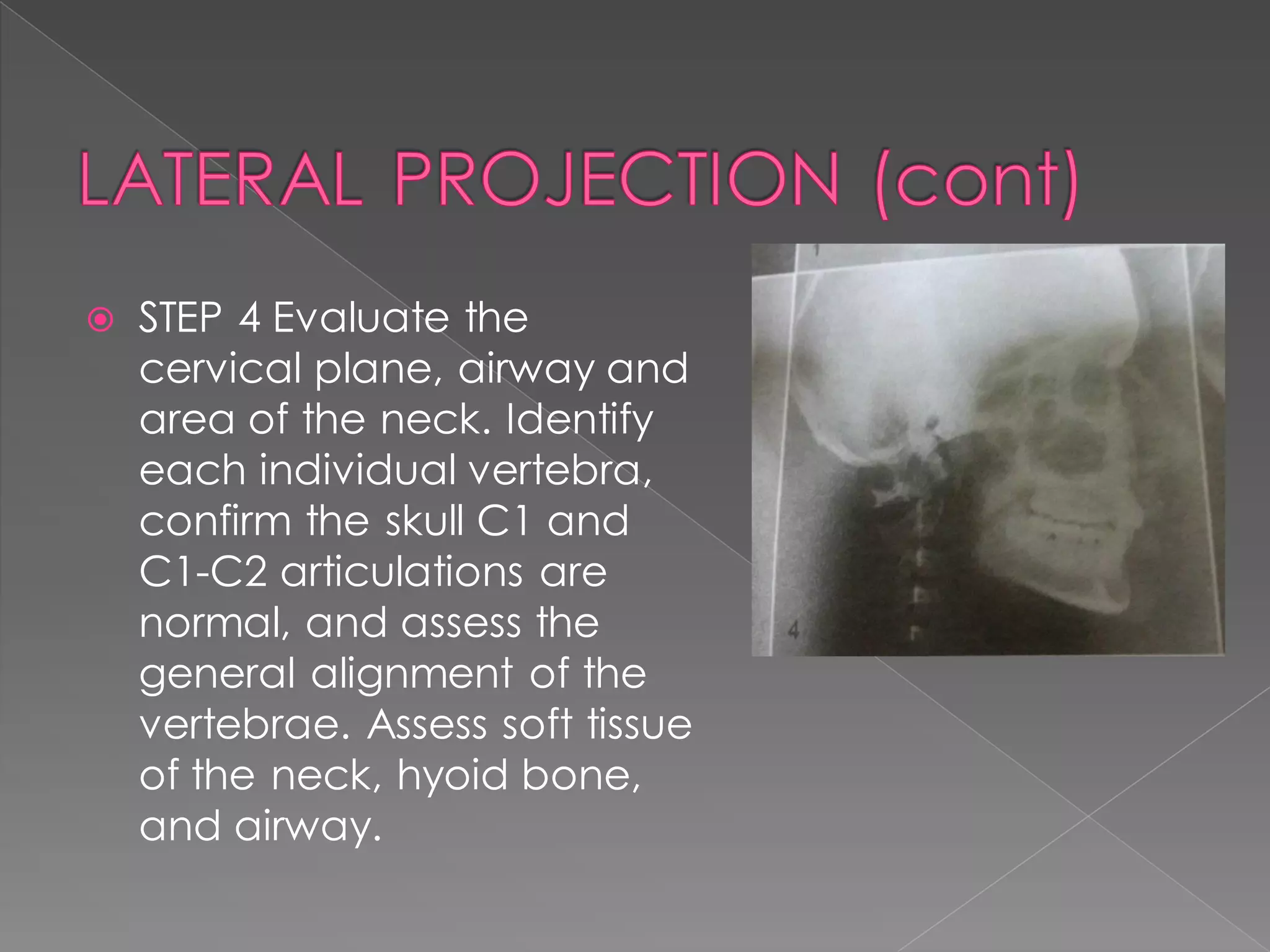  STEP 4 Evaluate the
cervical plane, airway and
area of the neck. Identify
each individual vertebra,
confirm the skull C1 and
C1-C2 articulations are
normal, and assess the
general alignment of the
vertebrae. Assess soft tissue
of the neck, hyoid bone,
and airway.
 