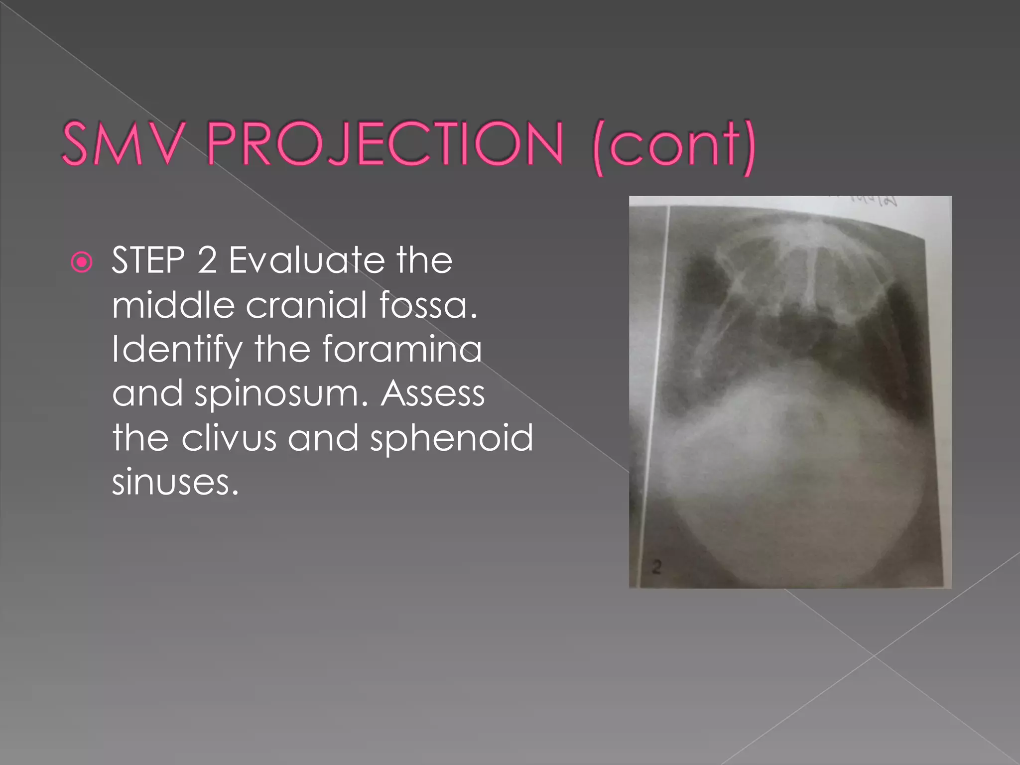  STEP 2 Evaluate the
middle cranial fossa.
Identify the foramina
and spinosum. Assess
the clivus and sphenoid
sinuses.
 