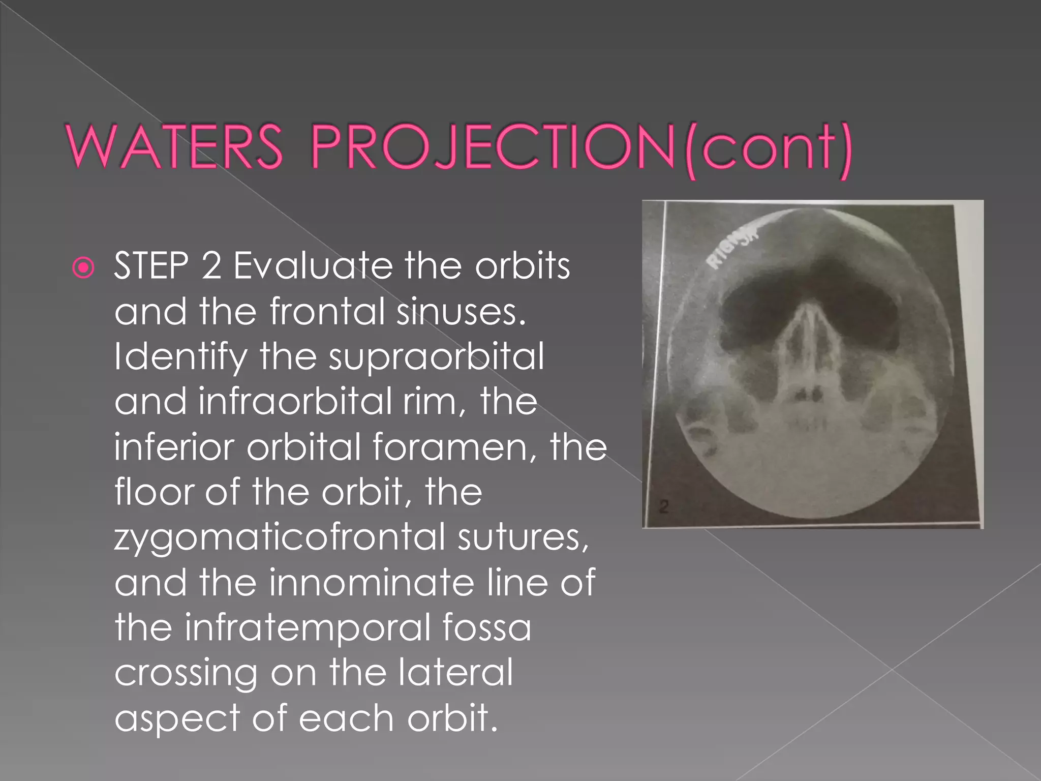  STEP 2 Evaluate the orbits
and the frontal sinuses.
Identify the supraorbital
and infraorbital rim, the
inferior orbital foramen, the
floor of the orbit, the
zygomaticofrontal sutures,
and the innominate line of
the infratemporal fossa
crossing on the lateral
aspect of each orbit.
 