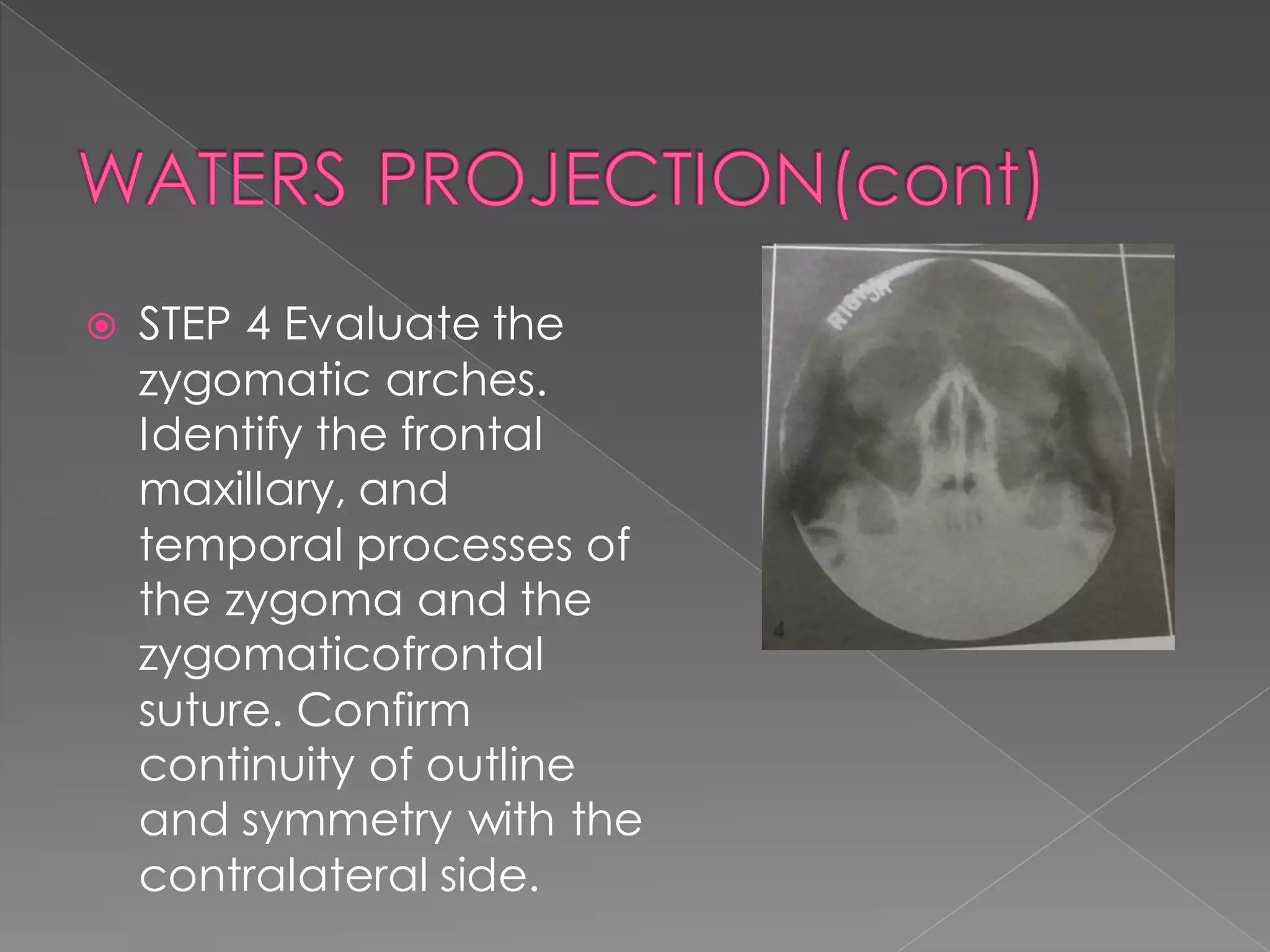  STEP 4 Evaluate the
zygomatic arches.
Identify the frontal
maxillary, and
temporal processes of
the zygoma and the
zygomaticofrontal
suture. Confirm
continuity of outline
and symmetry with the
contralateral side.
 