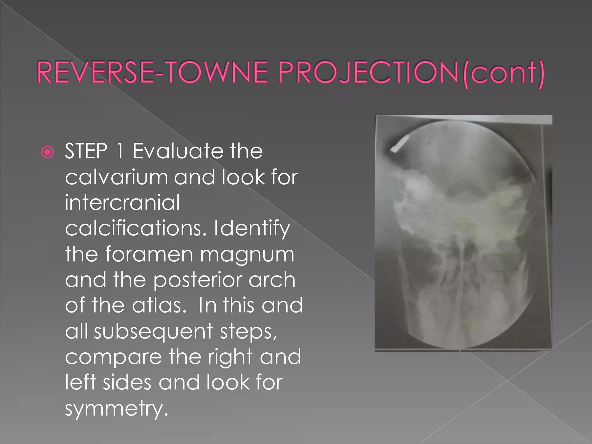  STEP 1 Evaluate the
calvarium and look for
intercranial
calcifications. Identify
the foramen magnum
and the posterior arch
of the atlas. In this and
all subsequent steps,
compare the right and
left sides and look for
symmetry.
 