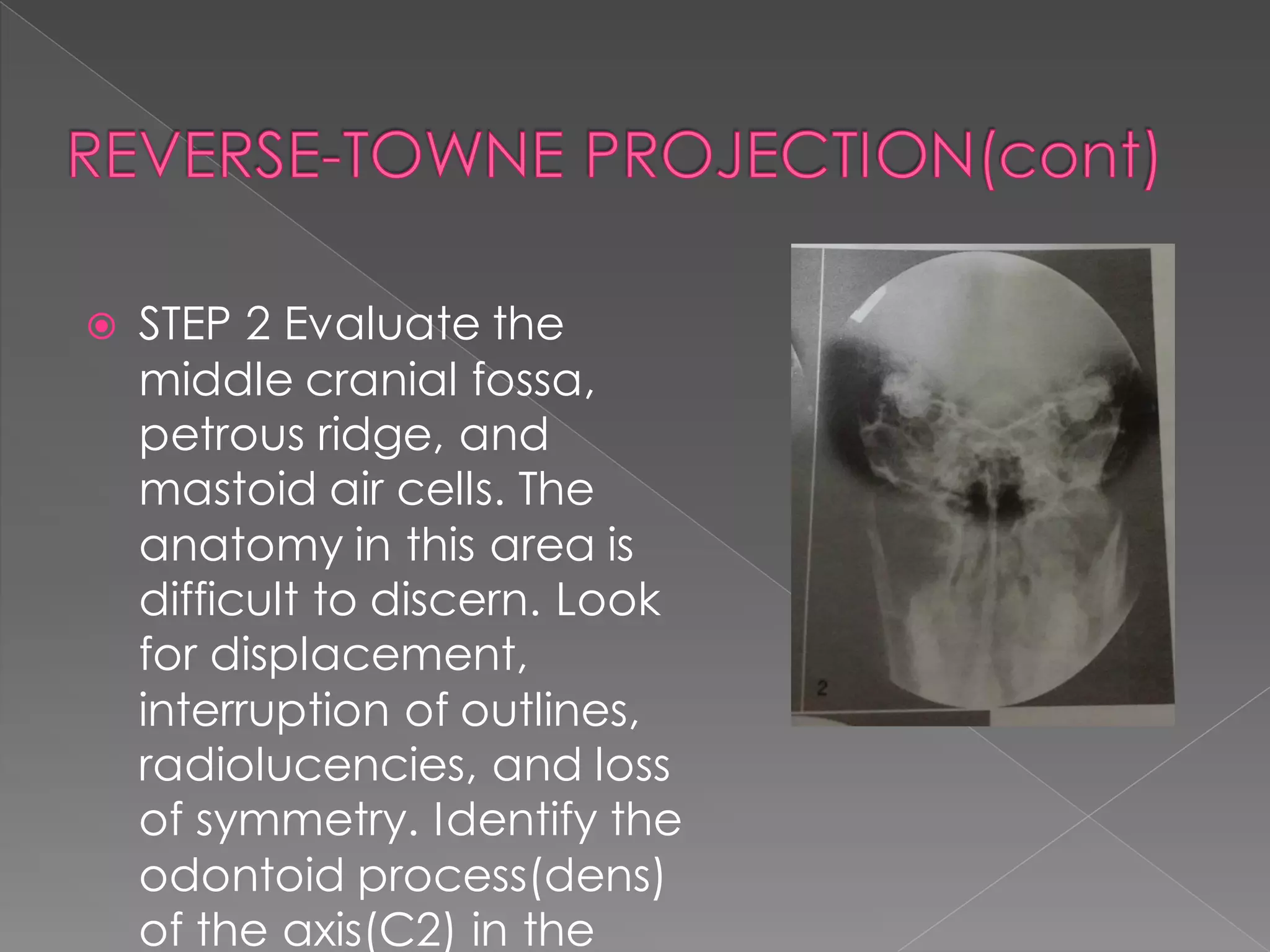  STEP 2 Evaluate the
middle cranial fossa,
petrous ridge, and
mastoid air cells. The
anatomy in this area is
difficult to discern. Look
for displacement,
interruption of outlines,
radiolucencies, and loss
of symmetry. Identify the
odontoid process(dens)
of the axis(C2) in the
 