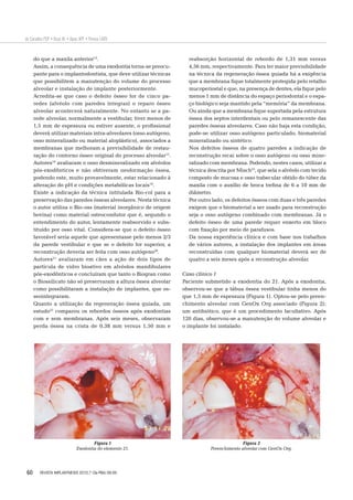 60
de Carvalho PSP • Rosa AL • Bassi APF • Pereira LAVD
do que a maxila anterior13
.
Assim, a consequência de uma exodontia torna-se preocu-
pante para o implantodontista, que deve utilizar técnicas
que possibilitem a manutenção do volume do processo
alveolar e instalação de implante posteriormente.
Acredita-se que caso o defeito ósseo for de cinco pa-
redes (alvéolo com paredes íntegras) o reparo ósseo
alveolar acontecerá naturalmente. No entanto se a pa-
rede alveolar, normalmente a vestibular, tiver menos de
1,5 mm de espessura ou estiver ausente, o proﬁssional
deverá utilizar materiais intra-alveolares (osso autógeno,
osso mineralizado ou material aloplástico), associados a
membranas que melhoram a previsibilidade de restau-
ração do contorno ósseo original do processo alveolar13
.
Autores18
avaliaram o osso desmineralizado em alvéolos
pós-exodônticos e não obtiveram neoformação óssea,
podendo este, muito provavelmente, estar relacionado à
alteração do pH e condições metabólicas locais19
.
Existe a indicação da técnica intitulada Bio-col para a
preservação das paredes ósseas alveolares. Nesta técnica
o autor utiliza o Bio-oss (material inorgânico de origem
bovina) como material osteocondutor que é, segundo o
entendimento do autor, lentamente reabsorvido e subs-
tituído por osso vital. Considera-se que o defeito ósseo
favorável seria aquele que apresentasse pelo menos 2/3
da parede vestibular e que se o defeito for superior, a
reconstrução deveria ser feita com osso autógeno20
.
Autores21
avaliaram em cães a ação de dois tipos de
partícula de vidro bioativo em alvéolos mandibulares
pós-exodônticos e concluíram que tanto o Biogran como
o Biossilicato não só preservaram a altura óssea alveolar
como possibilitaram a instalação de implantes, que os-
seointegraram.
Quanto a utilização da regeneração óssea guiada, um
estudo22
comparou os rebordos ósseos após exodontias
com e sem membranas. Após seis meses, observaram
perda óssea na crista de 0,38 mm versus 1,50 mm e
reabsorção horizontal de rebordo de 1,31 mm versus
4,56 mm, respectivamente. Para ter maior previsibilidade
na técnica da regeneração óssea guiada há a exigência
que a membrana ﬁque totalmente protegida pelo retalho
mucoperiostal e que, na presença de dentes, ela ﬁque pelo
menos 1 mm de distância do espaço periodontal e o espa-
ço biológico seja mantido pela “memória” da membrana.
Ou ainda que a membrana ﬁque suportada pela estrutura
óssea dos septos interdentais ou pelo remanescente das
paredes ósseas alveolares. Caso não haja esta condição,
pode-se utilizar osso autógeno particulado, biomaterial
mineralizado ou sintético.
Nos defeitos ósseos de quatro paredes a indicação de
reconstrução recai sobre o osso autógeno ou osso mine-
ralizado com membrana. Podendo, nestes casos, utilizar a
técnica descrita por Misch23
, que sela o alvéolo com tecido
composto de mucosa e osso trabecular obtido do túber da
maxila com o auxílio de broca treﬁna de 6 a 10 mm de
diâmetro.
Por outro lado, os defeitos ósseos com duas e três paredes
exigem que o biomaterial a ser usado para reconstrução
seja o osso autógeno combinado com membranas. Já o
defeito ósseo de uma parede requer enxerto em bloco
com ﬁxação por meio de parafusos.
Da nossa experiência clínica e com base nos trabalhos
de vários autores, a instalação dos implantes em áreas
reconstruídas com qualquer biomaterial deverá ser de
quatro a seis meses após a reconstrução alveolar.
Caso clínico 1
Paciente submetido a exodontia do 21. Após a exodontia,
observou-se que a tábua óssea vestibular tinha menos do
que 1,5 mm de espessura (Figura 1). Optou-se pelo preen-
chimento alveolar com GenOx Org associado (Figura 2);
um antibiótico, que é um procedimento facultativo. Após
120 dias, observou-se a manutenção do volume alveolar e
o implante foi instalado.
Figura 1
Exodontia do elemento 21.
Figura 2
Preenchimento alveolar com GenOx Org.
REVISTA IMPLANTNEWS 2010;7 (3a-PBA):56-65
 