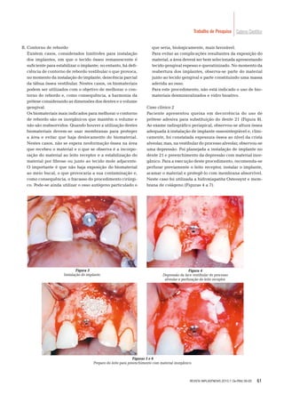 61
Caderno CientíﬁcoTrabalho de Pesquisa
B. Contorno de rebordo
Existem casos, considerados limítrofes para instalação
dos implantes, em que o tecido ósseo remanescente é
suﬁciente para estabilizar o implante; no entanto, há deﬁ-
ciência de contorno de rebordo vestibular o que provoca,
no momento da instalação do implante, deiscência parcial
da tábua óssea vestibular. Nestes casos, os biomateriais
podem ser utilizados com o objetivo de melhorar o con-
torno do rebordo e, como consequência, a harmonia da
prótese considerando as dimensões dos dentes e o volume
gengival.
Os biomateriais mais indicados para melhorar o contorno
de rebordo são os inorgânicos que mantém o volume e
não são reabsorvidos. Quando houver a utilização destes
biomateriais devem-se usar membranas para proteger
a área e evitar que haja deslocamento do biomaterial.
Nestes casos, não se espera neoformação óssea na área
que recebeu o material e o que se observa é a incorpo-
ração do material ao leito receptor e a estabilização do
material por ﬁbrose ou junto ao tecido mole adjacente.
O importante é que não haja exposição do biomaterial
ao meio bucal, o que provocaria a sua contaminação e,
como consequência, o fracasso do procedimento cirúrgi-
co. Pode-se ainda utilizar o osso autógeno particulado o
que seria, biologicamente, mais favorável.
Para evitar as complicações resultantes da exposição do
material, a área deverá ser bem selecionada apresentando
tecido gengival espesso e queratinizado. No momento da
reabertura dos implantes, observa-se parte do material
junto ao tecido gengival e parte constituindo uma massa
aderida ao osso.
Para este procedimento, não está indicado o uso de bio-
materiais desmineralizados e vidro bioativo.
Caso clínico 2
Paciente apresentou queixa em decorrência do uso de
prótese adesiva para substituição do dente 21 (Figura 8).
Ao exame radiográﬁco periapical, observou-se altura óssea
adequada à instalação de implante osseointegrável e, clini-
camente, foi constatada espessura óssea ao nível da crista
alveolar, mas, na vestibular do processo alveolar, observou-se
uma depressão. Foi planejada a instalação de implante no
dente 21 e preenchimento da depressão com material inor-
gânico. Para a execução deste procedimento, recomenda-se
perfurar previamente o leito receptor, instalar o implante,
acamar o material e protegê-lo com membrana absorvível.
Neste caso foi utilizada a hidroxiapatita Osteosynt e mem-
brana de colágeno (Figuras 4 a 7).
Figura 3
Instalação do implante.
Figura 4
Depressão da face vestibular do processo
alveolar e perfuração do leito receptor.
Figuras 5 e 6
Preparo do leito para preenchimento com material inorgânico.
REVISTA IMPLANTNEWS 2010;7 (3a-PBA):56-65
 