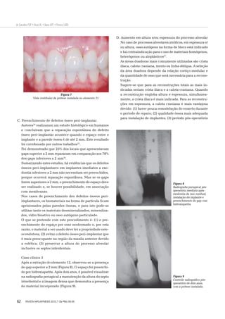 62
de Carvalho PSP • Rosa AL • Bassi APF • Pereira LAVD
C. Preenchimento de defeitos ósseo peri-implantar
Autores24
realizaram um estudo histológico em humanos
e concluíram que a reparação espontânea do defeito
ósseo peri-implantar acontece quando o espaço entre o
implante e a parede óssea é de até 2 mm. Este resultado
foi corroborado por outros trabalhos25
.
Foi demonstrado que 25% dos locais que apresentavam
gaps superior a 2 mm repararam em comparação aos 78%
dos gaps inferiores a 2 mm26
.
Sumarizando estes estudos, há evidências que os defeitos
ósseos peri-implantares em implantes imediatos a exo-
dontia inferiores a 2 mm não necessitam ser preenchidos,
porque ocorrerá reparação espontânea. Mas se os gaps
forem superiores a 2 mm, o preenchimento do espaço deve
ser realizado e, se houver possibilidade, em associação
com membranas.
Nos casos de preenchimento dos defeitos ósseos peri-
implantares, os biomateriais na forma de partícula ﬁcam
aprisionados pelas paredes ósseas, e para isto pode-se
utilizar tanto os materiais desmineralizados, mineraliza-
dos, vidro bioativo ou osso autógeno particulado.
O que se pretende com este procedimento é: (1) o pre-
enchimento do espaço por osso neoformado e, por esta
razão, o material a ser usado deve ter a propriedade oste-
ocondutora; (2) evitar o defeito ósseo peri-implantar que
é mais preocupante na região da maxila anterior devido
a estética; (3) preservar a altura do processo alveolar
inclusive os septos interdentais.
Caso clínico 3
Após a extração do elemento 12, observou-se a presença
de gap superior a 2 mm (Figura 8). O espaço foi preenchi-
do por hidroxiapatita. Após dois anos, é possível visualizar
na radiograﬁa periapical a manutenção da altura do septo
interdental e a imagem densa que demonstra a presença
do material incorporado (Figura 9).
D. Aumento em altura e/ou espessura do processo alveolar
No caso de processos alveolares atróﬁcos, em espessura e/
ou altura, osso autógeno na forma de bloco está indicado
e há contraindicação para o uso de materiais homógenos,
heterógenos ou aloplásticos27
.
As áreas doadoras mais comumente utilizadas são crista
ilíaca, calota craniana, mento ou linha oblíqua. A seleção
da área doadora depende da relação cortiço-medular e
da quantidade de osso que será necessária para a recons-
trução.
Sugere-se que para as reconstruções totais as mais in-
dicadas seriam crista ilíaca e a calota craniana. Quando
a reconstrução engloba altura e espessura, simultanea-
mente, a crista ilíaca é mais indicada. Para as reconstru-
ções em espessura, a calota craniana é mais vantajosa
devido: (1) haver pouca remodelação do enxerto durante
o período de reparo; (2) qualidade óssea mais adequada
para instalação de implantes; (3) período pós-operatório
Figura 7
Vista vestibular da prótese instalada no elemento 21.
Figura 8
Radiograﬁa periapical pós-
operatória imediata após
exodontia da raiz residual,
instalação do implante e
preenchimento do gap com
hidroxiapatita.
Figura 9
Controle radiográﬁco pós-
operatório de dois anos,
com a prótese instalada.
REVISTA IMPLANTNEWS 2010;7 (3a-PBA):56-65
 
