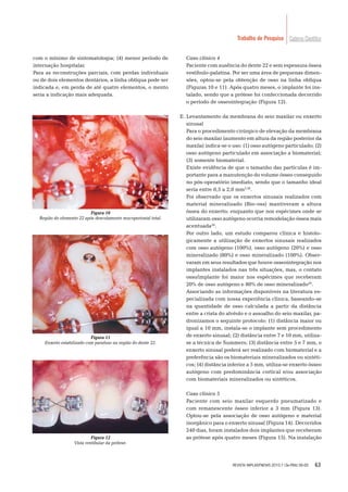 63
Caderno CientíﬁcoTrabalho de Pesquisa
com o mínimo de sintomatologia; (4) menor período de
internação hospitalar.
Para as reconstruções parciais, com perdas individuais
ou de dois elementos dentários, a linha oblíqua pode ser
indicada e, em perda de até quatro elementos, o mento
seria a indicação mais adequada.
Caso clínico 4
Paciente com ausência do dente 22 e sem espessura óssea
vestíbulo-palatina. Por ser uma área de pequenas dimen-
sões, optou-se pela obtenção de osso na linha oblíqua
(Figuras 10 e 11). Após quatro meses, o implante foi ins-
talado, sendo que a prótese foi confeccionada decorrido
o período de osseointegração (Figura 12).
E. Levantamento da membrana do seio maxilar ou enxerto
sinusal
Para o procedimento cirúrgico de elevação da membrana
do seio maxilar (aumento em altura da região posterior da
maxila) indica-se o uso: (1) osso autógeno particulado; (2)
osso autógeno particulado em associação a biomaterial;
(3) somente biomaterial.
Existe evidência de que o tamanho das partículas é im-
portante para a manutenção do volume ósseo conseguido
no pós-operatório imediato, sendo que o tamanho ideal
seria entre 0,5 a 2,0 mm3,28
.
Foi observado que os enxertos sinusais realizados com
material mineralizado (Bio-oss) mantiveram a altura
óssea do enxerto; enquanto que nos espécimes onde se
utilizaram osso autógeno ocorria remodelação óssea mais
acentuada28
.
Por outro lado, um estudo comparou clínica e histolo-
gicamente a utilização de enxertos sinusais realizados
com osso autógeno (100%), osso autógeno (20%) e osso
mineralizado (80%) e osso mineralizado (100%). Obser-
varam em seus resultados que houve osseointegração nos
implantes instalados nas três situações, mas, o contato
osso/implante foi maior nos espécimes que receberam
20% de osso autógeno e 80% de osso mineralizado29
.
Associando as informações disponíveis na literatura es-
pecializada com nossa experiência clínica, baseando-se
na quantidade de osso calculada a partir da distância
entre a crista do alvéolo e o assoalho do seio maxilar, pa-
dronizamos o seguinte protocolo: (1) distância maior ou
igual a 10 mm, instala-se o implante sem procedimento
de enxerto sinusal; (2) distância entre 7 e 10 mm, utiliza-
se a técnica de Summers; (3) distância entre 5 e 7 mm, o
enxerto sinusal poderá ser realizado com biomaterial e a
preferência são os biomateriais mineralizados ou sintéti-
cos; (4) distância inferior a 5 mm, utiliza-se enxerto ósseo
autógeno com predominância cortical e/ou associação
com biomateriais mineralizados ou sintéticos.
Caso clínico 5
Paciente com seio maxilar esquerdo pneumatizado e
com remanescente ósseo inferior a 3 mm (Figura 13).
Optou-se pela associação de osso autógeno e material
inorgânico para o enxerto sinusal (Figura 14). Decorridos
240 dias, foram instalados dois implantes que receberam
as prótese após quatro meses (Figura 15). Na instalação
Figura 10
Região do elemento 22 após descolamento mucoperiostal total.
Figura 11
Enxerto estabilizado com parafuso na região do dente 22.
Figura 12
Vista vestibular da prótese.
REVISTA IMPLANTNEWS 2010;7 (3a-PBA):56-65
 