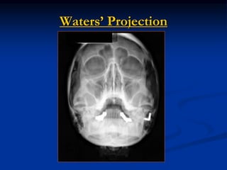 Extra oral Radiography | PPSX