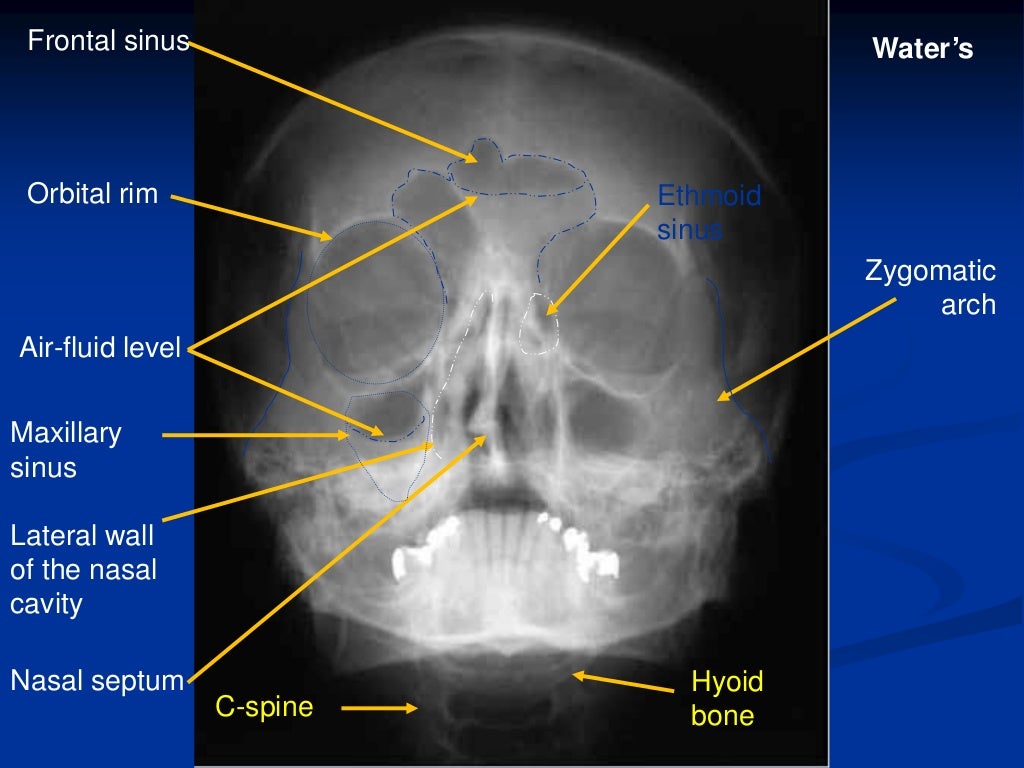 Extra oral Radiography