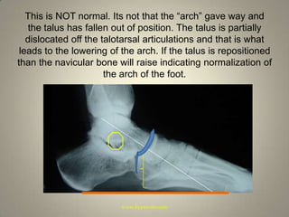 This is NOT normal. Its not that the “arch” gave way and the talus has fallen out of position. The talus is partially dislocated off the talotarsal articulations and that is what leads to the lowering of the arch. If the talus is repositioned than the navicular bone will raise indicating normalization of the arch of the foot.www.hyprocure.com