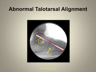 Abnormal Talotarsal Alignmentwww.hyprocure.com
