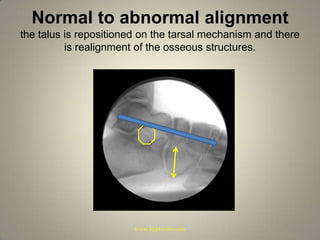 Normal to abnormal alignmentthe talus is repositioned on the tarsal mechanism and there is realignment of the osseous structures.www.hyprocure.com