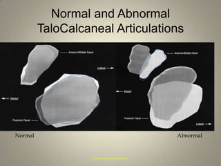 Normal and Abnormal TaloCalcaneal ArticulationsNormalAbnormalwww.hyprocure.com