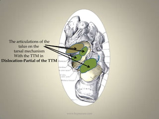 The articulations of thetalus on the tarsal mechanismWith the TTM in Dislocation-Partial of the TTMwww.hyprocure.com