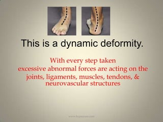 This is a dynamic deformity.With every step takenexcessive abnormal forces are acting on thejoints, ligaments, muscles, tendons, & neurovascular structureswww.hyprocure.com