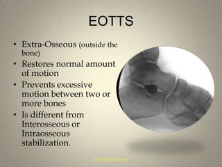 EOTTSExtra-Osseous (outside the bone)Restores normal amount of motionPrevents excessive motion between two or more bonesIs different from Interosseous or Intraosseous  stabilization.www.hyprocure.com
