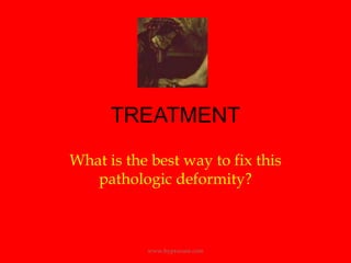 TREATMENTWhat is the best way to fix this pathologic deformity?www.hyprocure.com
