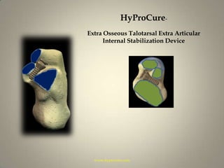 HyProCure- Extra Osseous Talotarsal Extra Articular Internal Stabilization Devicewww.hyprocure.com