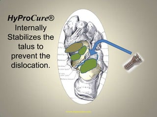 HyProCure® Internally Stabilizes the talus to prevent the dislocation.www.hyprocure.com
