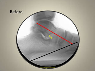 Beforewww.hyprocure.com