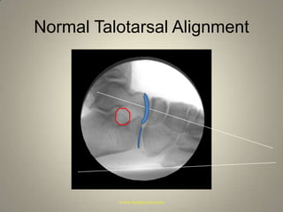 Normal Talotarsal Alignmentwww.hyprocure.com