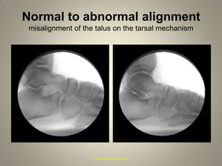Normal to abnormal alignmentmisalignment of the talus on the tarsal mechanismwww.hyprocure.com