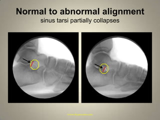 Normal to abnormal alignmentsinus tarsi partially collapseswww.hyprocure.com