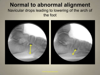 Normal to abnormal alignmentNavicular drops leading to lowering of the arch of the footwww.hyprocure.com