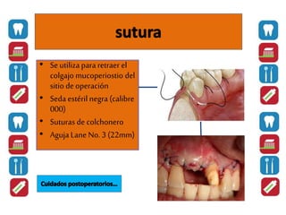 • Se utiliza para retraer el
colgajo mucoperiostio del
sitio de operación
• Seda estéril negra (calibre
000)
• Suturas de colchonero
• Aguja Lane No. 3 (22mm)
 