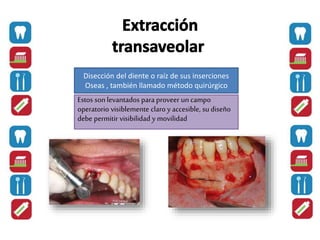 Disección del diente o raíz de sus inserciones
Oseas , también llamado método quirúrgico
Estos son levantados para proveer un campo
operatorio visiblemente claro y accesible, su diseño
debe permitir visibilidad y movilidad
 