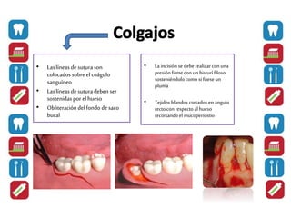 • Laslíneas de suturason
colocados sobre el coágulo
sanguíneo
• Laslíneas de suturadeben ser
sostenidaspor elhueso
• Obliteración del fondo de saco
bucal
• La incisión se deberealizarconuna
presiónfirmecon un bisturí filoso
sosteniéndolo como si fueseun
pluma
• Tejidos blandos cortados enángulo
recto con respectoal hueso
recortando elmucoperiostio
 