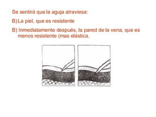 Se sentirá que la aguja atraviesa:  La piel, que es resistente  B) Inmediatamente después, la pared de la vena, que es menos resistente (mas elástica.  