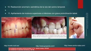  10. Reabsorción anormal o asimétrica de la raíz del canino temporal.

 11. Apiñamiento de incisivos superiores e inferiores con grave proinclinación labial.
http://scielo.isciii.es/ http://www.gruporie.com/ http://www.centro-kala.com/
T G. ortodoncia, principios y tenicas actuales. In T G..: elsevier mosby p. 439-442.
J U. ortodoncia. In. barcelona: barcelona p. 152-155.
 
