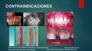 CONTRAINDICACIONES
/www.ortodoncia.wsANALISIS FOTOGRAFICO PERFIL Jackeline Mulett
Vásquez Departamento de infancia http://www.odontobebe.odontovida.com/
 