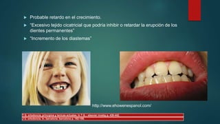  Probable retardo en el crecimiento.
 “Excesivo tejido cicatricial que podría inhibir o retardar la erupción de los
dientes permanentes”
 “Incremento de los diastemas”
http://www.ehowenespanol.com/
T G. ortodoncia, principios y tenicas actuales. In T G..: elsevier mosby p. 439-442.
J U. ortodoncia. In. barcelona: barcelona p. 152-155.
 