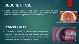  Esta fase se realiza a partir de los 9.5 años, aquí se extraen los cuatro
primeros molares temporales. Esto ayuda a la erupción del primer
premolar cuando éste tenga la mitad de su raíz formada.
SEGUNDA FASE
TERCERA FASE:
 En esta fase se procede a la extracción de los cuatro primeros
premolares. Para que esta fase sea favorable debe haber
erupcionado los primeros premolares antes que los caninos,
favoreciendo con esto a una migración de caninos
Imágenes tomadas de: Dr. Alfredo Morales- México año 2009c
 