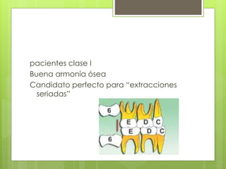 pacientes clase I
Buena armonía ósea
Candidato perfecto para “extracciones
seriadas”
 