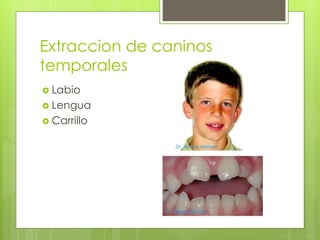 Extraccion de caninos
temporales
 Labio
 Lengua
 Carrillo
 