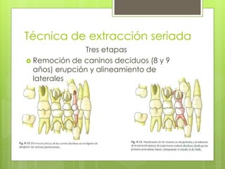 Técnica de extracción seriada
Tres etapas
 Remoción de caninos deciduos (8 y 9
años) erupción y alineamiento de
laterales
 